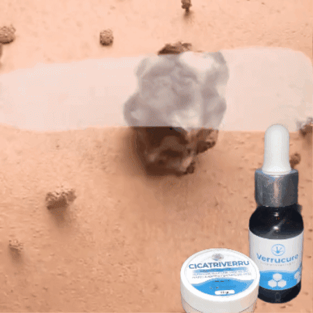 VERRUCURE + CICATRIVERRU DE REGALO 🎁